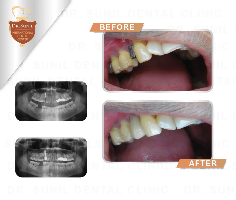 Thailand Dental Implant in bangkok